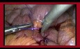 Technique de suture intracorporelle laparoscopique
