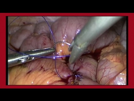 Technique de suture intracorporelle laparoscopique