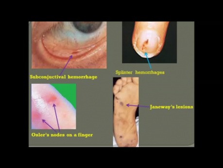 Endocardite - symptômes, diagnostic et échocardiographie