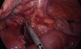 Iliectomie Laparoscopique pour la Maladie de Crohn par ICG et Fluorescence
