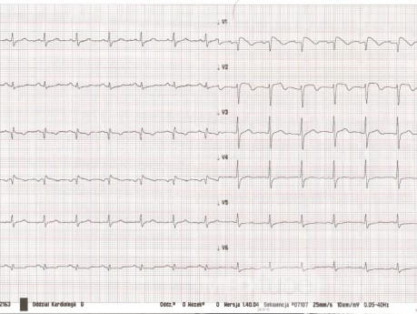 Le syndrome de Brugada - ECG