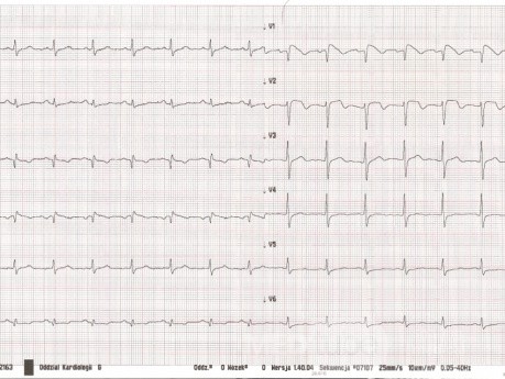 Le syndrome de Brugada - ECG