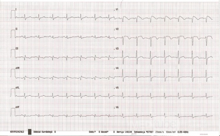 Le syndrome de Brugada - ECG