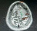 Planification Chirurgicale avec Neuronavigation chez un Patient présentant une Masse Intracrânienne. Gliome de haut grade.