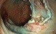 La dissection sous-muqueuse endoscopique de la tumeur rectale 2