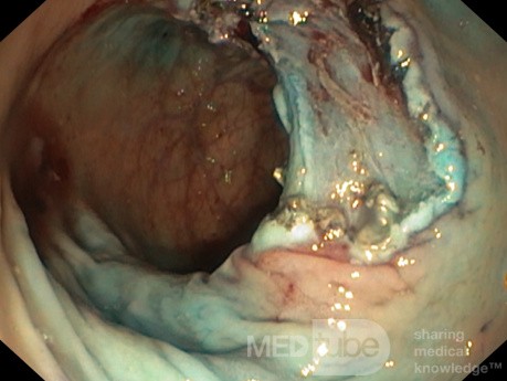 La dissection sous-muqueuse endoscopique de la tumeur rectale 2