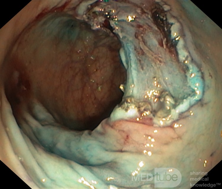 La dissection sous-muqueuse endoscopique de la tumeur rectale 2