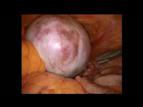 Annexectomie - ablation du tératome ovarien
