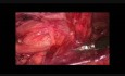 Réparation de la hernie inguinale par méthode laparoscopique trans-abdominal pré-péritonéal (TAPP) en utilisant un filet 3D