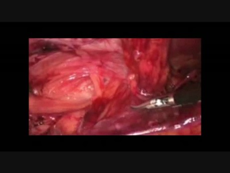 Réparation de la hernie inguinale par méthode laparoscopique trans-abdominal pré-péritonéal (TAPP) en utilisant un filet 3D