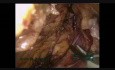 Résection d'un cancer d'une flexion colique droite - hémicolectomie droite élargie par laparoscopie