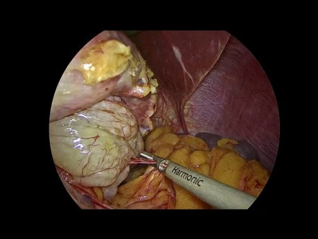Résection Laparoscopique de GIST Gastrique (Tumeur Stromale Gastro-Intestinale)