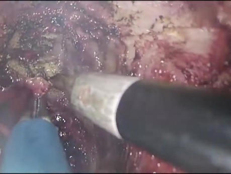 Proctectomie TAMIS avec Anastomose Colo-Anale par Traction "Turnbull-Cutait" pour Fistules Recto-Urétrales