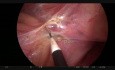 Résection antérieure par laparoscopie avec coloscopie sur la table d'opération