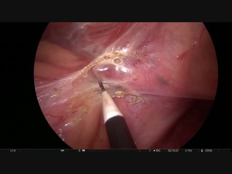 Résection antérieure par laparoscopie avec coloscopie sur la table d'opération