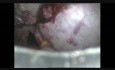 Ablation laparoscopique d'un gros kyste ovarien sans rupture