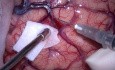 Méningiome de l'atrium du ventricule latéral gauche - Résection microscopique
