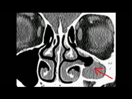 Atélectasie du sinus maxillaire gauche