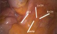 Approche Oncologique Laparoscopique de Cancer du Rectum