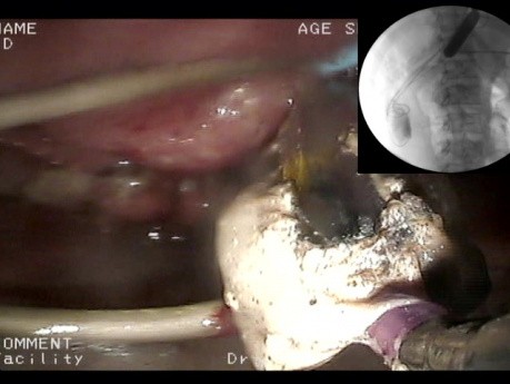 Traitement endoscopique des séquelles d'une pancréatite aiguë nécrosante