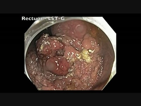 Rectum: LST-G