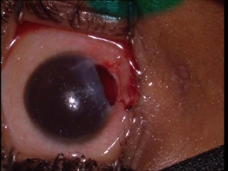 Lésion oculaire (zone 2)