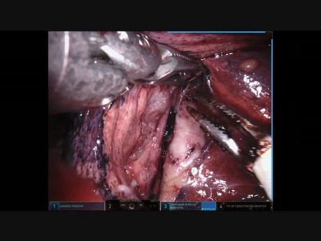 Segmentectomie pulmonaire anatomique assistée par robot