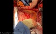 Transplantation Pulmonaire - Partie 1 - Prélèvement