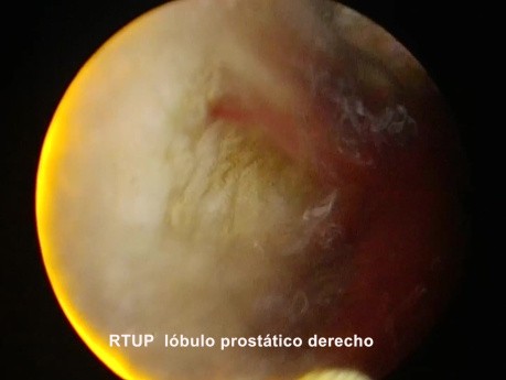 Cancer de la Prostate. Résection Transurétrale Radicale.