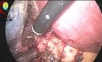 Vous Devriez Avoir au Moins un Abord de 10 mm Pendant la Cholécystectomie Laparoscopique