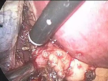 Vous Devriez Avoir au Moins un Abord de 10 mm Pendant la Cholécystectomie Laparoscopique