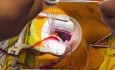 Remplacement de Valve Aortique par Minithoracotomie Antérieure Droite