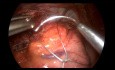 Reprise de Fundoplicature Nissen avec le Placement de Filet Hiatal Lentement Résorbable