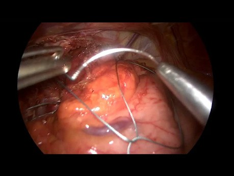 Reprise de Fundoplicature Nissen avec le Placement de Filet Hiatal Lentement Résorbable