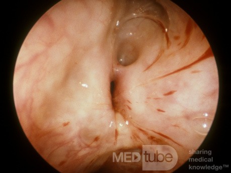 Ostium naturel du sinus maxillaire vu de l'intérieur du sinus maxillaire