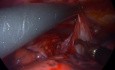 Kyste bronchogène médiastinal chez un garçon de 10 ans