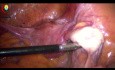 Examination des Annexes et du Côlon sigmoïde dans l'Abdomen Chirurgical