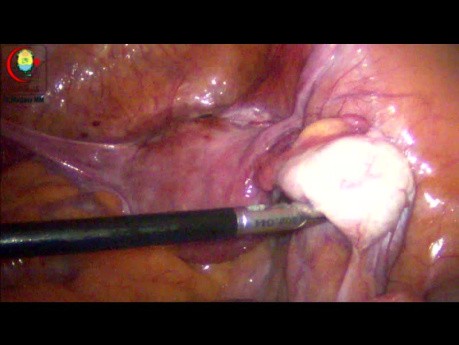 Examination des Annexes et du Côlon sigmoïde dans l'Abdomen Chirurgical