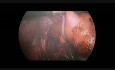Réfundoplicature de Nissen par cœlioscopie chez un enfant de 17 mois