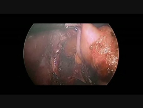 Réfundoplicature de Nissen par cœlioscopie chez un enfant de 17 mois