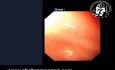 Endoscopie d'Achalasie in Situs Inversus Totalis
