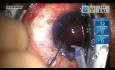 Chirurgie de la Cataracte avec Sauvetage par Capsulorrhexis Postérieur