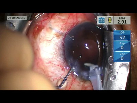 Chirurgie de la Cataracte avec Sauvetage par Capsulorrhexis Postérieur