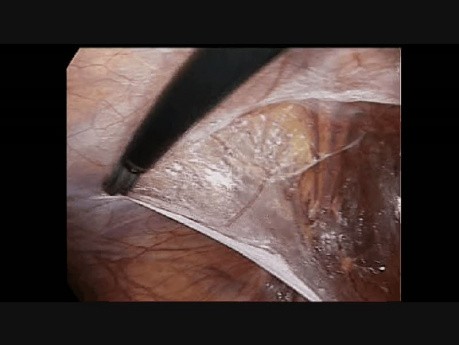Traitement de la hernie inguinale par coelioscopie. Étape 3: Incision du péritoine à gauche