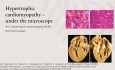 Échocardiographie et Imagerie Cardiovasculaire Multimodale dans la Cardiomyopathie Hypertrophique (Mise à jour 2022)