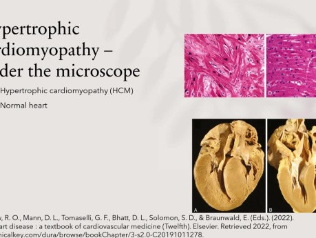 Échocardiographie et Imagerie Cardiovasculaire Multimodale dans la Cardiomyopathie Hypertrophique (Mise à jour 2022)