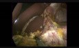 Gastrectomie partielle par laparoscopie avec un curage ganglionnaire de type D2 et une reconstruction par une anse de Roux en Y
