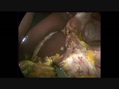 Gastrectomie partielle par laparoscopie avec un curage ganglionnaire de type D2 et une reconstruction par une anse de Roux en Y