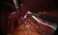 Traitement laparoscopique de la hernie hiatale