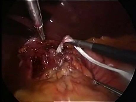 Traitement laparoscopique de la hernie hiatale